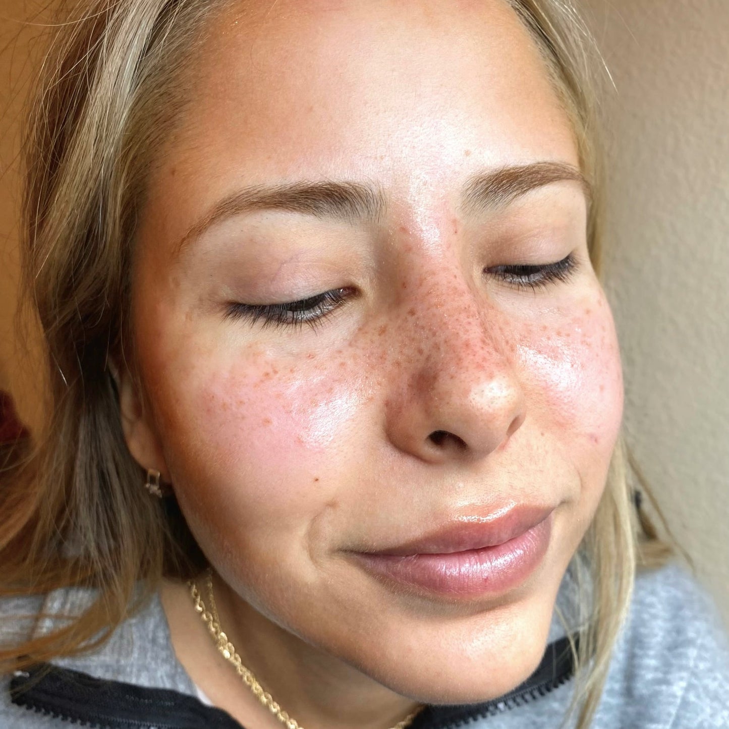 Micropigmentación de Pecas