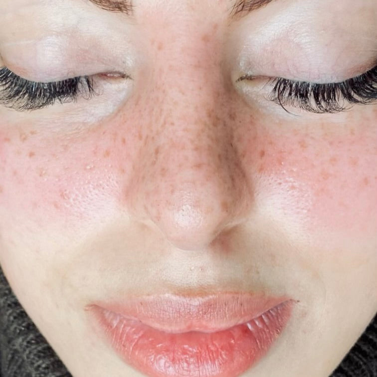 Micropigmentación de Pecas