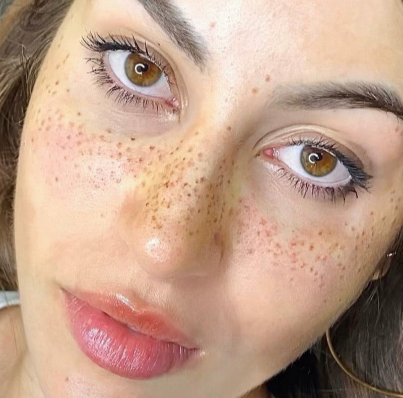 Micropigmentación de Pecas