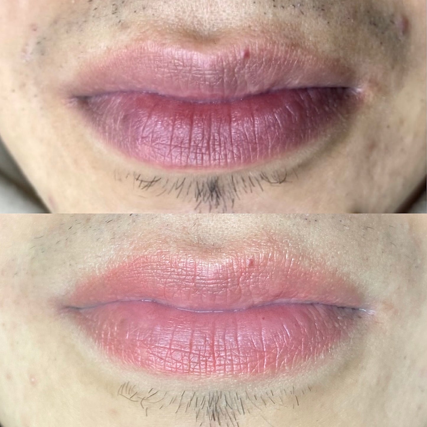 Neutralización Labios Oscuros