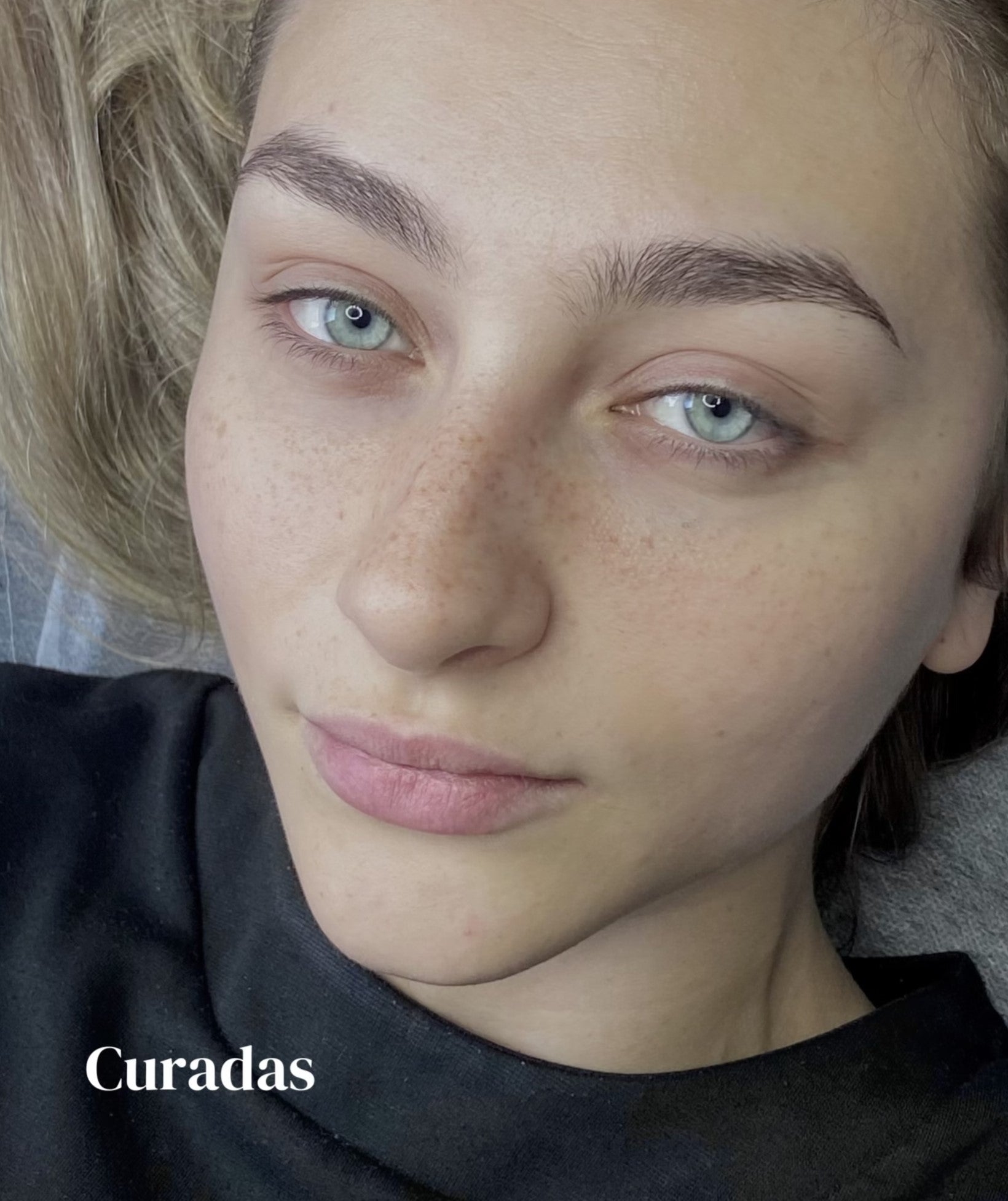 freckling madrid