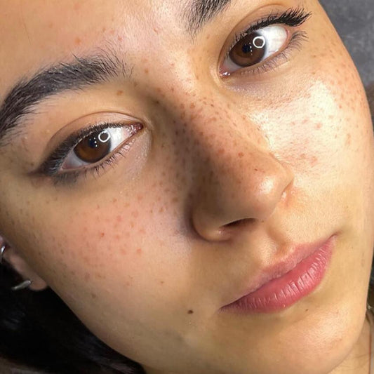 Micropigmentación de pecas