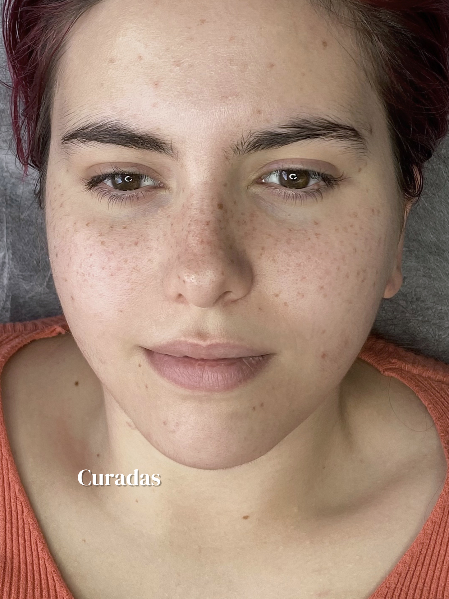 micropigmentacion pecas